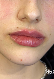 An image of the Client after undergoing Lip Filler