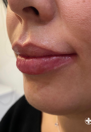 An image of the Client after undergoing Lip Filler