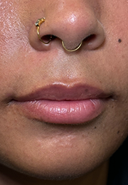 An image of the Client before undergoing Lip Filler