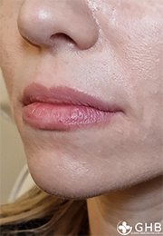 An image of the Client before undergoing Lip Filler