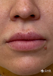 An image of the Client before undergoing Lip Filler