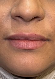 An image of the Client before undergoing Lip Filler