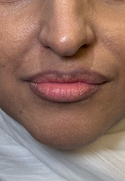 An image of the Client before undergoing Lip Filler