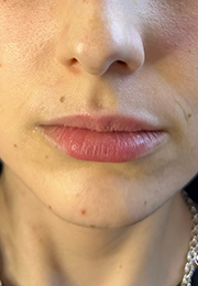 An image of the Client before undergoing Lip Filler