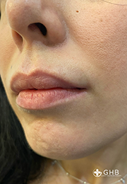 An image of the Client before undergoing Lip Filler