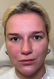 An image of the Client after undergoing Nasolabial Fold Filler