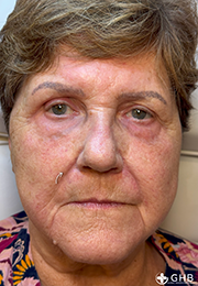 An image of the Client after undergoing Nasolabial Fold Filler