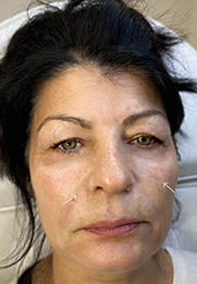 An image of the Client after undergoing Nasolabial Fold Filler