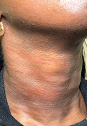 An image of the Client after undergoing Neck & Decollete Rejuvenation Treatment