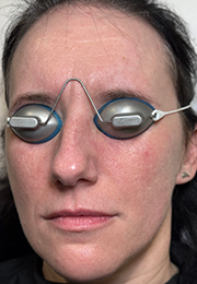 An image of the Client after undergoing Laser Redness Reduction Treatment