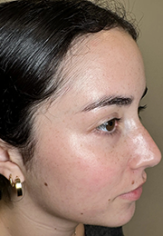 An image of the Client after undergoing Laser Redness Reduction Treatment