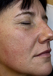 An image of the Client before undergoing Laser Redness Reduction Treatment