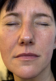 An image of the Client before undergoing Laser Redness Reduction Treatment