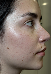 An image of the Client before undergoing Laser Redness Reduction Treatment