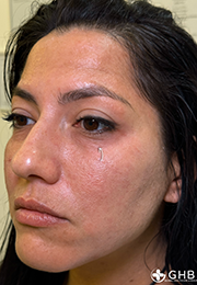 An image of the Client after undergoing Tear Trough Filler