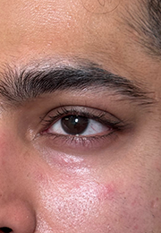 An image of the Client after undergoing Tear Trough Filler