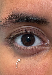 An image of the Client after undergoing Tear Trough Filler