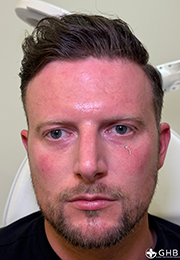 An image of the Client after undergoing Tear Trough Filler