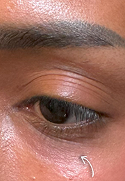 An image of the Client after undergoing Mesotherapy