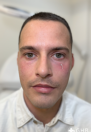 An image of the Client after undergoing Tear Trough Filler