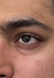 An image of the Client before undergoing Tear Trough Filler