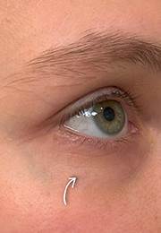 An image of the Client before undergoing Tear Trough Filler