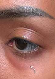 An image of the Client before undergoing Mesotherapy